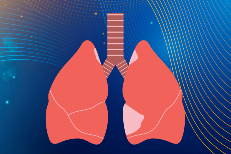 Imagem de Tuberculose | Doença Infectocontagiosa