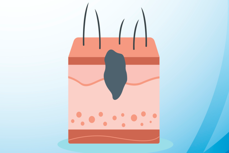 Imagem de Biópsia Incisional ou Excisional