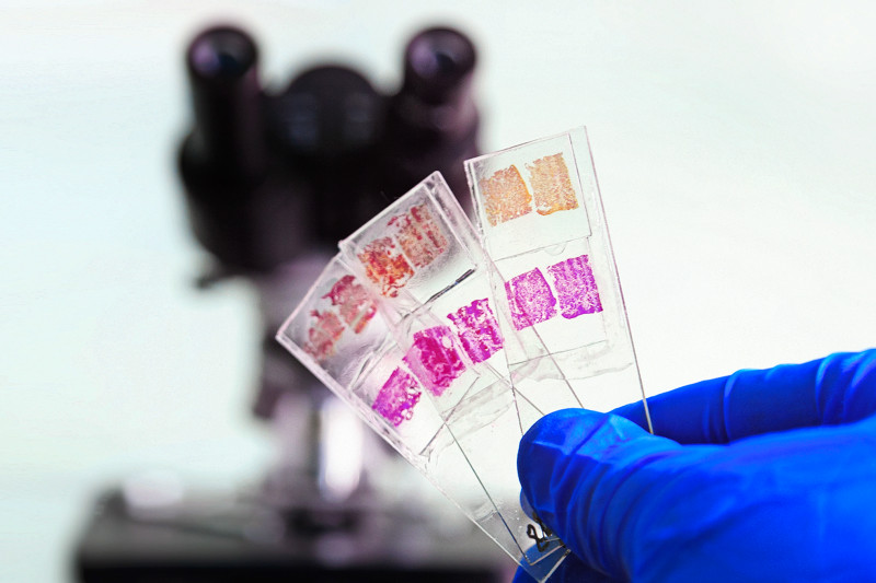 Imagem de 4 Benefícios da Biópsia