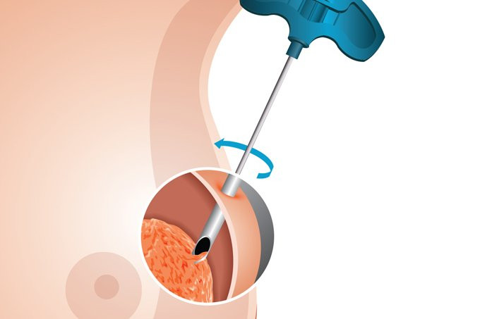Imagem de Biópsia ou Punção Aspirativa | Qual a Diferença?