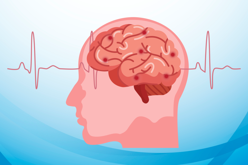 Imagem de Câncer Cerebral