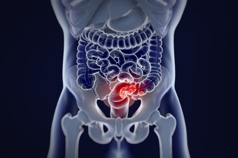 Imagem de 5 Maneiras de Prevenir o Câncer Colorretal