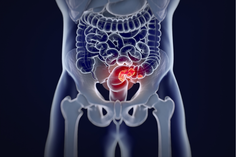 Imagem de Câncer Colorretal