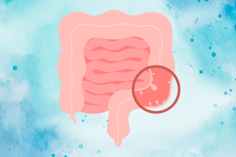 Imagem de Câncer Colorretal | Sintomas e Diagnóstico