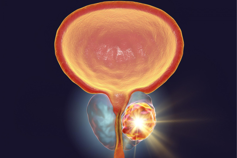 Imagem de Câncer de Próstata