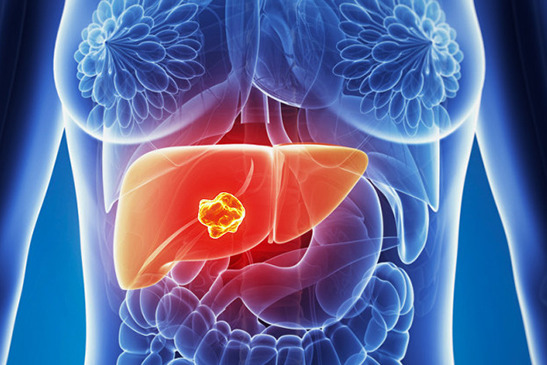 Imagem de Câncer de Fígado