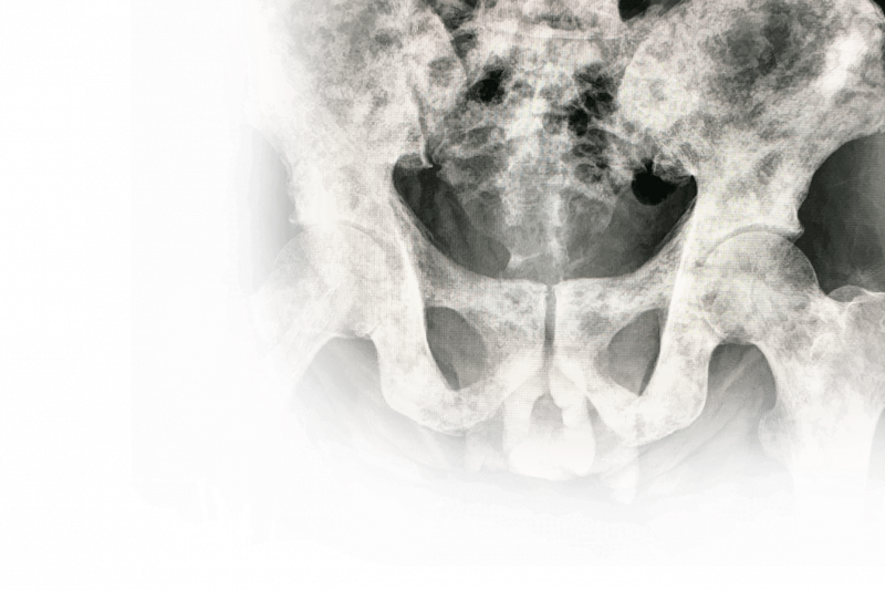 Imagem de Câncer Ósseo 