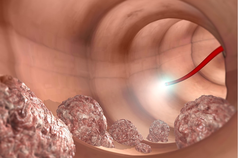 Imagem de Colonoscopia | Diagnóstico do Câncer Colorretal