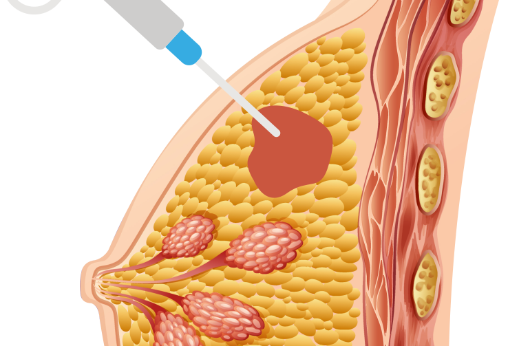 Imagem de Core Biopsy e Mamotomia