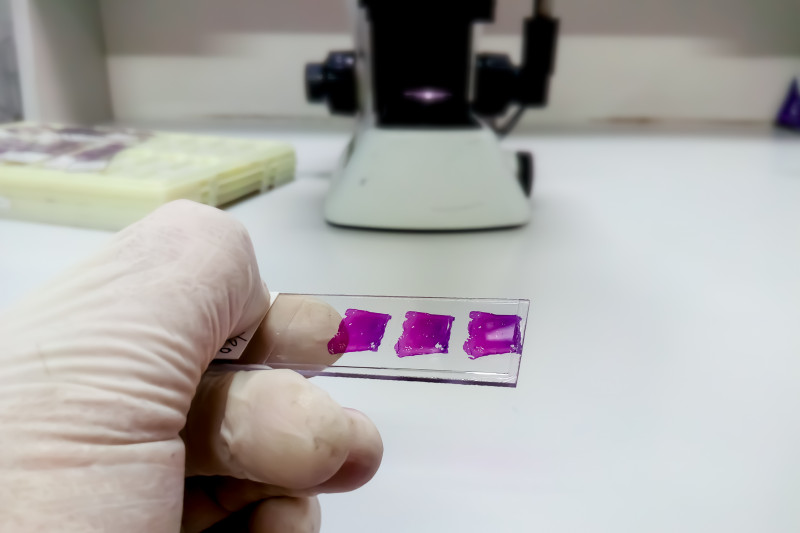 Imagem de Doenças Diagnosticadas por Biópsia