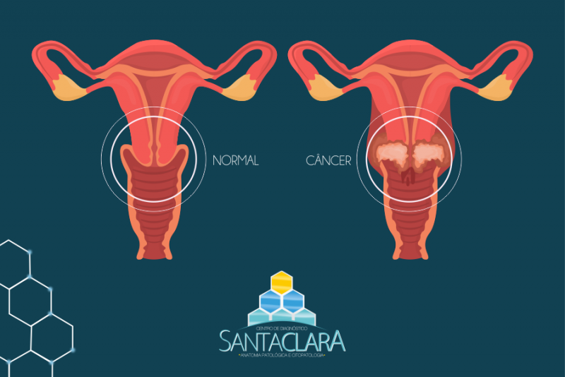 Imagem de Câncer do Colo do Útero | Fique Atenta aos Sintomas