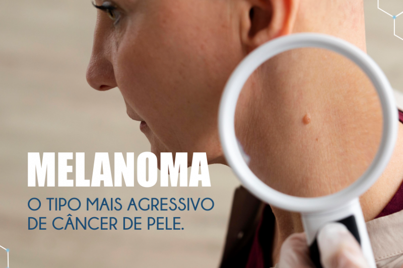Imagem de Melanoma