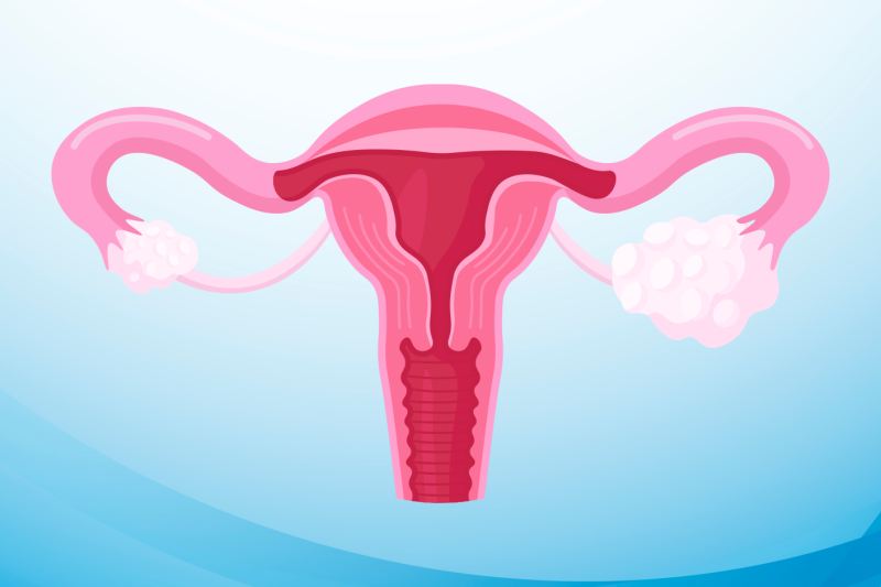 Imagem de Ovário Policístico