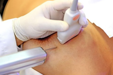 Imagem de Punção Aspirativa - Veja o Passo a Passo