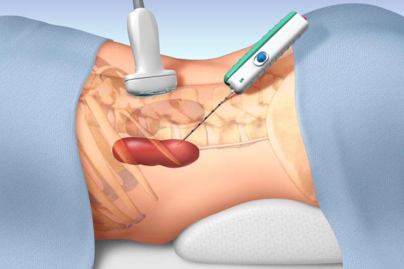 Imagem de PAAF – Punção Aspirativa 