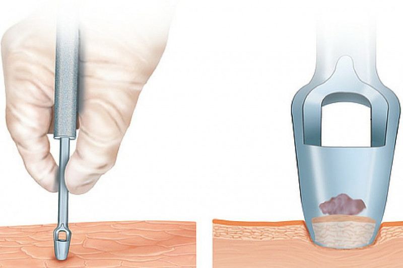 Imagem de Tipos de Biópsia