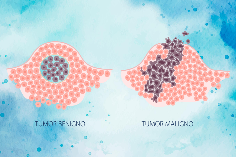 Imagem de Tipos de Neoplasias