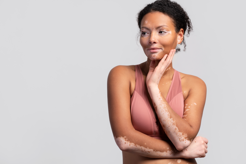 Imagem de Vitiligo | Quando a Biópsia é Indicada