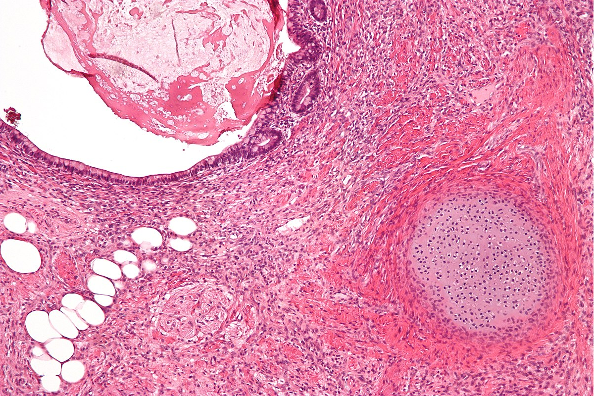 Background de Biópsias cirúrgicas Complexas