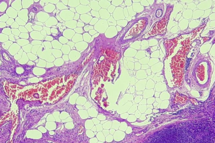 Background de Biópsia de Congelação (Pré-Operatória)