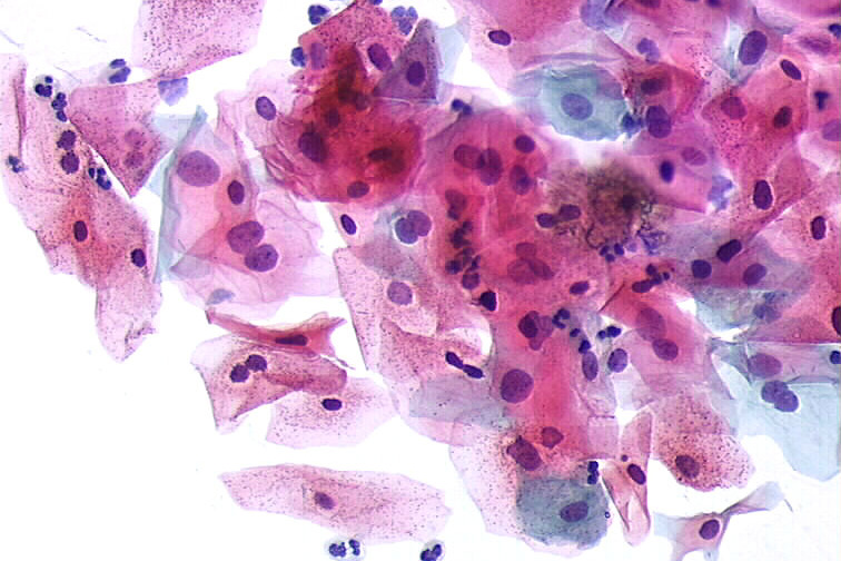 Imagem de Citologia cérvico-vaginal - Papanicolau (Convencional e em Meio Líquido)