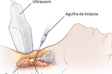 Imagem de Punção aspirativa por agulha fina (PAAF)